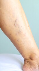 Fototapeta premium Leg Varicose Veins Medical Examination Closeup