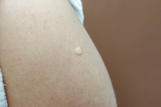 Close-up of a normal skin reaction after a Monkeypox vaccination, showing a small raised bump at the injection site. This papule is a common immune response following immunization.