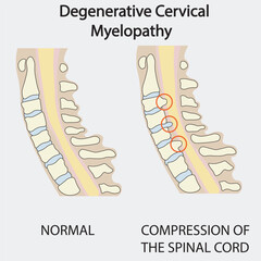 Degenerative cervical myelopathy vector: shows spinal cord compression with symptoms like neck pain, numbness, weakness, balance issues; similar diseases include MS, ALS, cervical radiculopathy. icon
