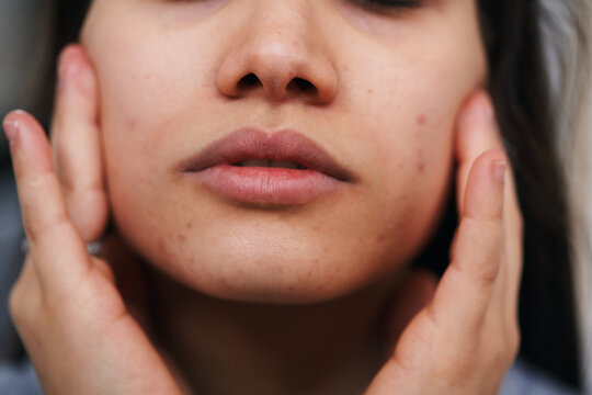 A person gently touches their face, revealing skin with visible blemishes and imperfections. This close-up highlights skincare concerns and self-care practices.