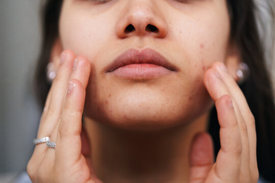 A young woman gently touches her face, revealing visible acne and skin blemishes. This close-up highlights common dermatological concerns and skin care needs.