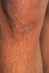 Fototapeta premium Close-up of sweaty hairy leg showing skin texture and small scar