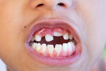 Child showing missing milk teeth and growing permanent teeth