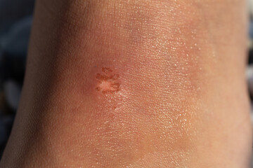 Fototapeta premium Close-up of infected wound showing signs of healing on human skin