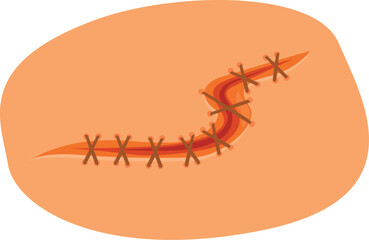 Surgical suture closing a wound with stitches on skin, healthcare and first aid concept