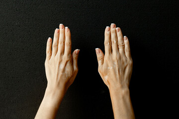 Woman's folded hands. Skin stained with vitiligo. Vitiligo on the hands of a middle-aged woman