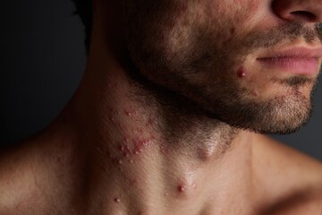 Obraz premium Illustrate a male patient s skin issues including allergies hives dermatitis dark spots acne freckles blemishes blackheads and pimples in a healthcare context