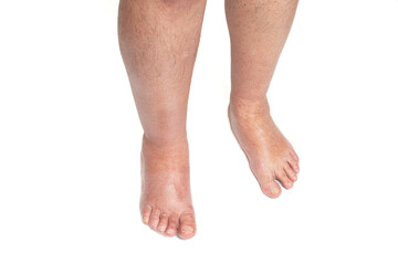 Swollen leg caused by a broken toe. Unrecognizable man with swollen feet, tired and painful legs.Edema lower limbs