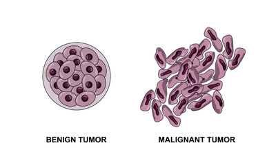 Vector illustrations of malignant and benign tumors in body tissues. Spread of cancer cells. Medical vector illustrations for education, posters, clinics, and science.
