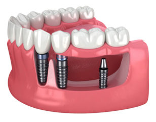 A 3D illustration of dental implants placed in the lower jaw, showing the titanium screws and porcelain crowns.