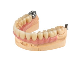 A 3D model of a lower dental arch with a partial denture, illustrating a prosthetic solution for missing teeth.