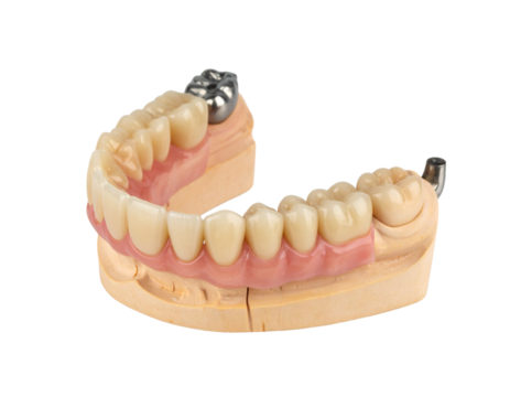 A 3D model of a lower dental arch with a partial denture, illustrating a prosthetic solution for missing teeth.
