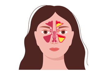 Sinusitis medical poster