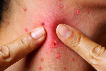Naklejka premium Close up of a person s neck with acne and pimples
