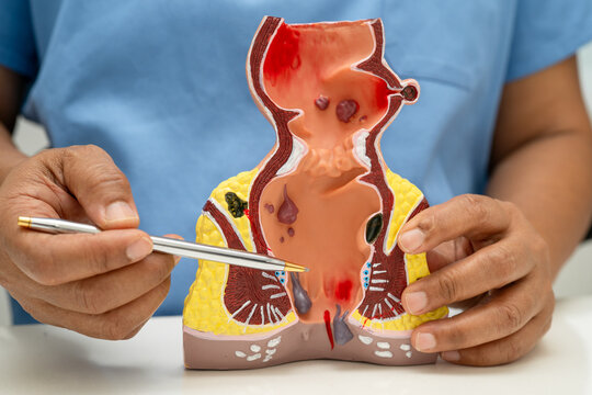 Asian doctor with rectum and hemorrhoid human anatomy model at hospital, inflamed vascular structure.