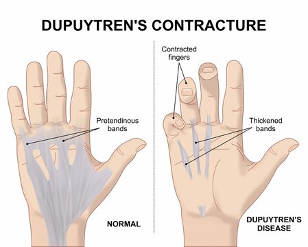 Dupuytren's Contracture hand finger illustration