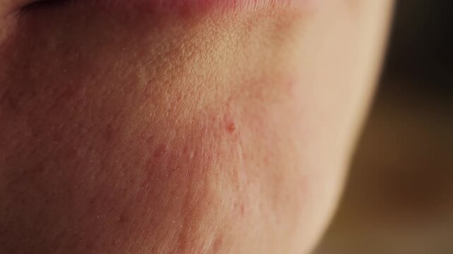 Skin imperfections concept, close-up acne on chin. 