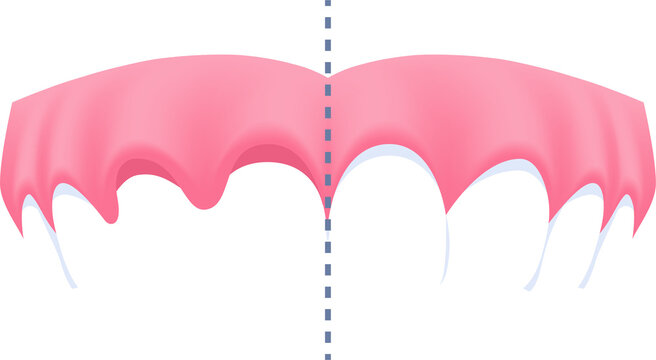 Upper teeth - Lost tooth (Before and After Comparison) illustration transparent design. Dental care concept.