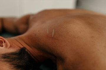 Naklejka premium Patient receiving acupuncture treatment on back and neck