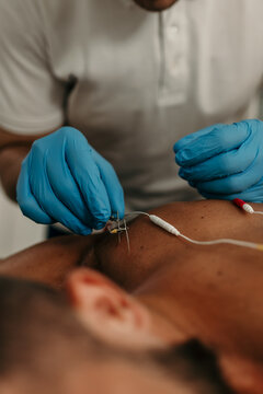 Doctor applying electroacupuncture dry needling to patient shoulder