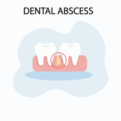 Dental abscess vector: shows swelling, severe toothache, fever, pus buildup. Highlights similar diseases like gum infection and tooth decay.icon
