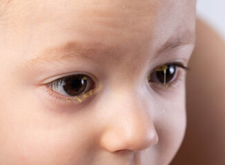 Bacterial infection in the eyes of a little boy, conjunctivitis, pus in the eyes, close-up