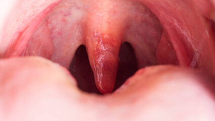 Uvulitis and sore throat in the oral cavity due to illness. Inflammation of the uvula and tonsils...