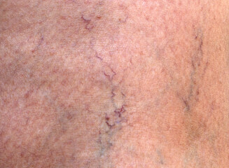 Fototapeta premium Skin with varicose veins