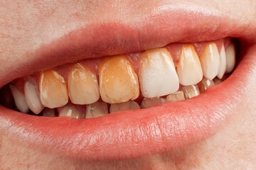Close-up view of discolored teeth in a person's smile revealing dental hygiene issues