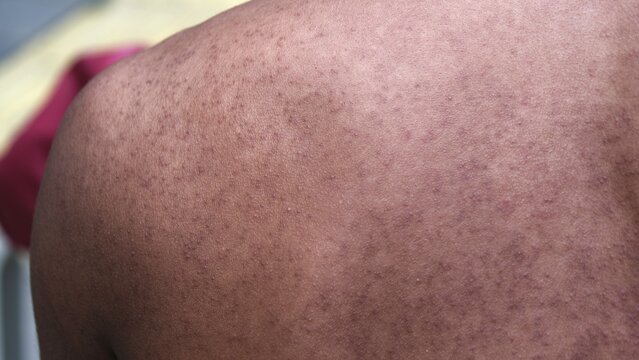 Prickly heat on a man back.
Miliaria, commonly known as heat rash, sweat rash, is a skin disease marked by small, itchy rashes due to sweat trapped under the skin by clogged sweat gland ducts. 