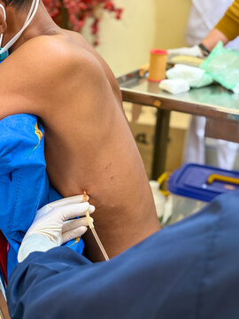 Doctor performing pleural puncture procedure on patient