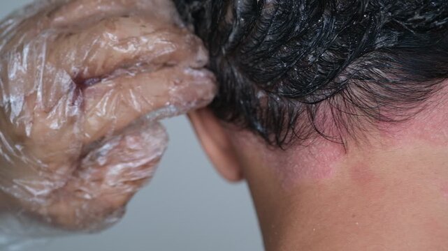 Is it permissible to dye hair on a scalp that is suffering from Psoriasis?