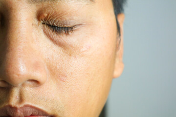 Xanthelasma or small skin blemishes that happen due to a buildup of fats under the surface of the eyelids skin. Sign of high cholesterol. Malay Asian lady. Tanned and dry skin. Dermatology.