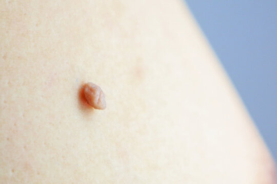 Birthmark of Papiloma neoplasm on human skin closeup