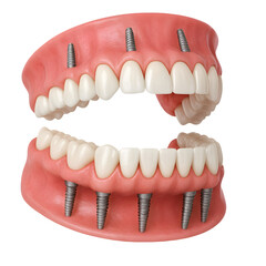 Obraz premium 3D Illustration of Dental Implants in Upper and Lower Jaw 