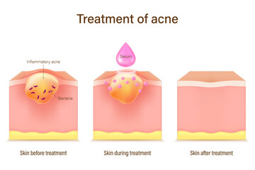 Treatment of acne. Skin layers before, during and after treatment. Acne skin and healthy skin. Treating acne with acne serum.