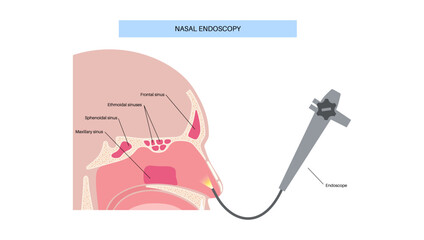 Nasal endoscopy poster © pikovit