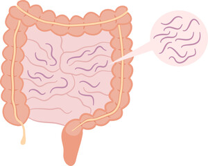 Worm infection in human digestive system