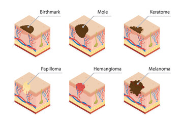 Human normal mole, birthmark, papilloma virus, hemangioma, keratome, melanoma. Human skin cross section. 3d isometric flat illustration.