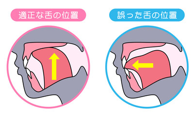 正しいミューイングの方法　適正な舌の位置と誤った舌の位置 © koti
