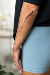 Injury featuring Healing Scars located on the Arm, signifying a journey of recovery and care