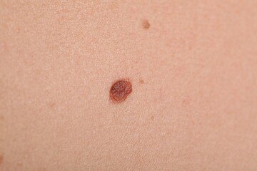 Woman with moles on her body, closeup