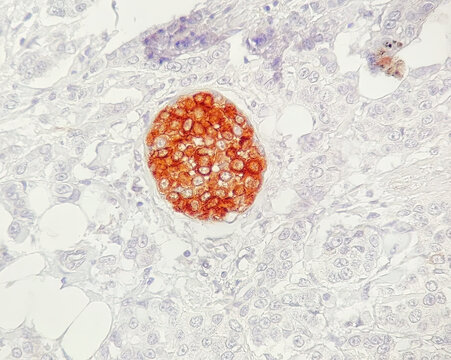 Epithelial Membrane Antigen