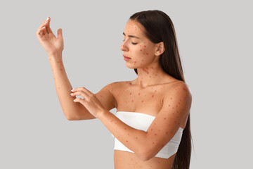 Young woman ill with chickenpox scratching on light background