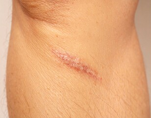 Fototapeta premium Surgical Scar on Leg – Close-Up