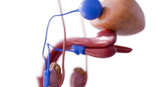 A 3D medical illustration of a male urogenital system with an implanted medical device, an artificial urinary sphincter. 