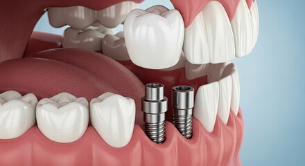 4k full hd photo open mouth showing dental implants and crowns, illustrating tooth replacement and oral health