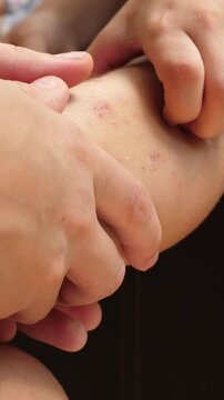 Mosquito bite on leg skin of little child girl. Red swollen area with irritation. Close up of insect damage. Pediatric skin detail. Health and care concept for young child