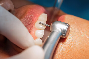 Macro view of a dentist using a rotary drill to prepare tooth surface for veneer placement. Concept of cosmetic dentistry, tooth preparation, and precision dental work.