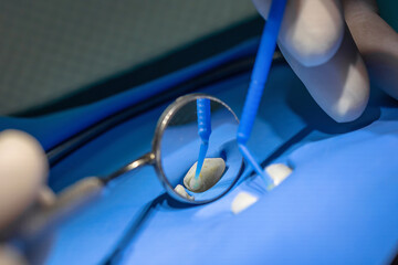 Close-up of dentist applying adhesive on isolated tooth using microbrush applicators with dental mirror. Concept of bonding, veneer preparation, and cosmetic dentistry.